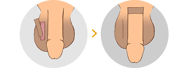 음낭부분 피판술